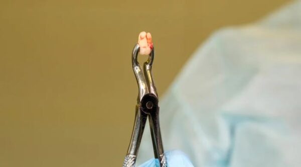 Understanding Tooth Extraction 